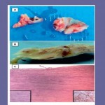 Images de la valve à l'examen anatomo-pathologique et à l'examen histologique Source : British Journal of Clinica pharmacology