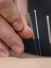 acupuncture-1.jpg (auregime.fr)